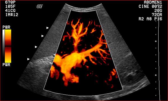 La Ecografía Doppler