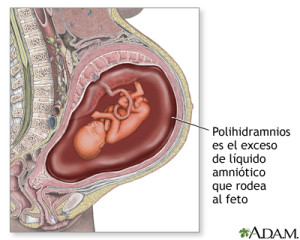 Hidramnios