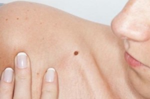 ¿Un lunar en la piel o un aviso de cáncer?