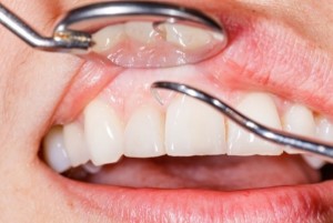 Cómo eliminar la placa dental
